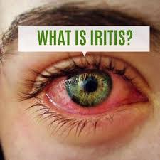 Qu’est-ce que l’iritis et pourquoi se produit-elle ?