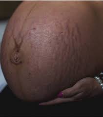 Vergetures sur le ventre pendant la grossesse Comment les limiter ?